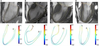 Left Ventricular Wall Stress Is Sensitive Marker of Hypertrophic Cardiomyopathy With Preserved Ejection Fraction